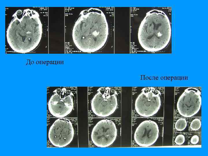 До операции После операции 
