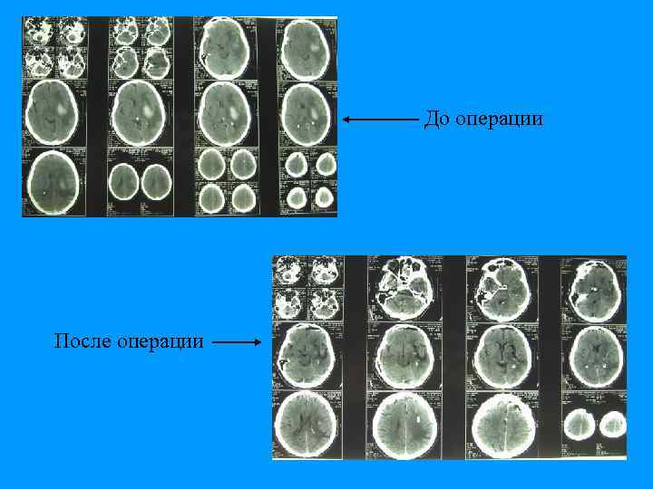 До операции После операции 
