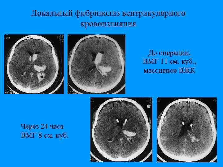 Локальный фибринолиз вентрикулярного кровоизлияния До операции. ВМГ 11 см. куб. , массивное ВЖК Через