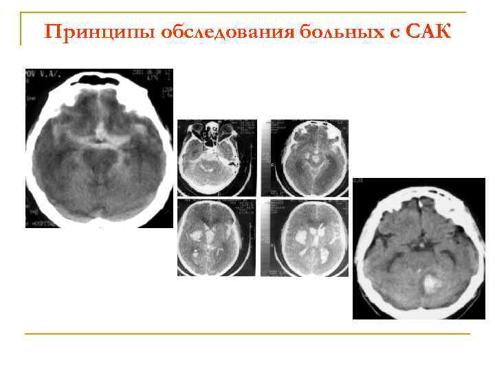 Принципы обследования больных с САК 