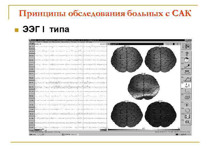 Принципы обследования больных с САК n ЭЭГ I типа 