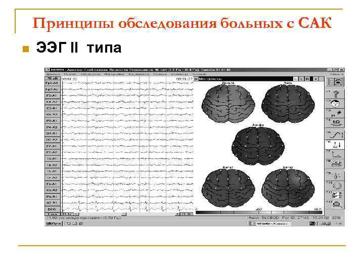 Принципы обследования больных с САК n ЭЭГ II типа 