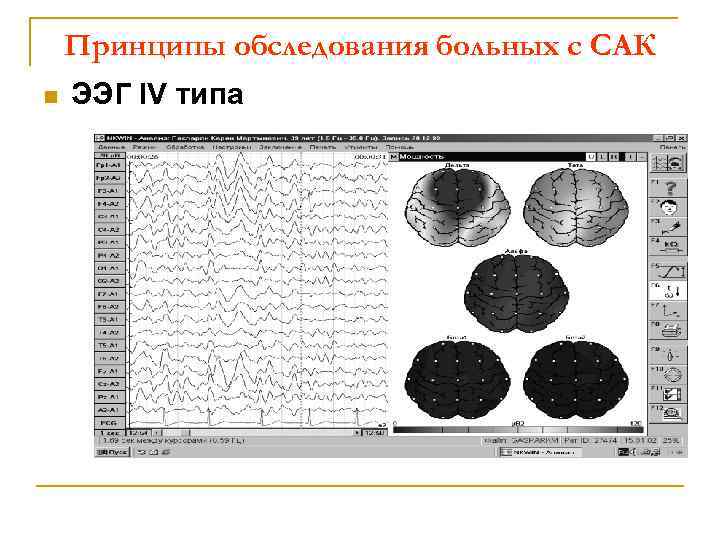 Принципы обследования больных с САК n ЭЭГ IV типа 