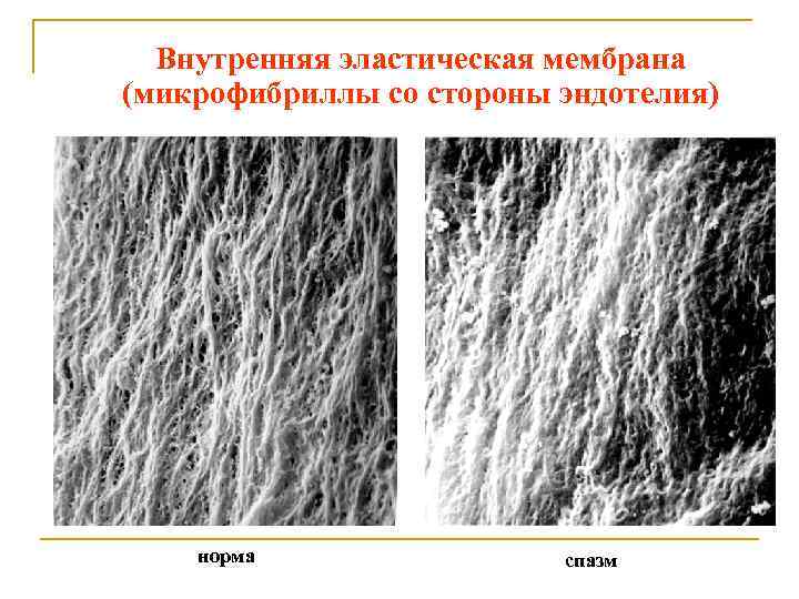 Внутренняя эластическая мембрана (микрофибриллы со стороны эндотелия) норма спазм 