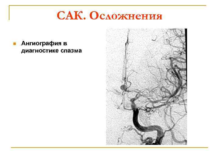 САК. Осложнения n Ангиография в диагностике спазма 