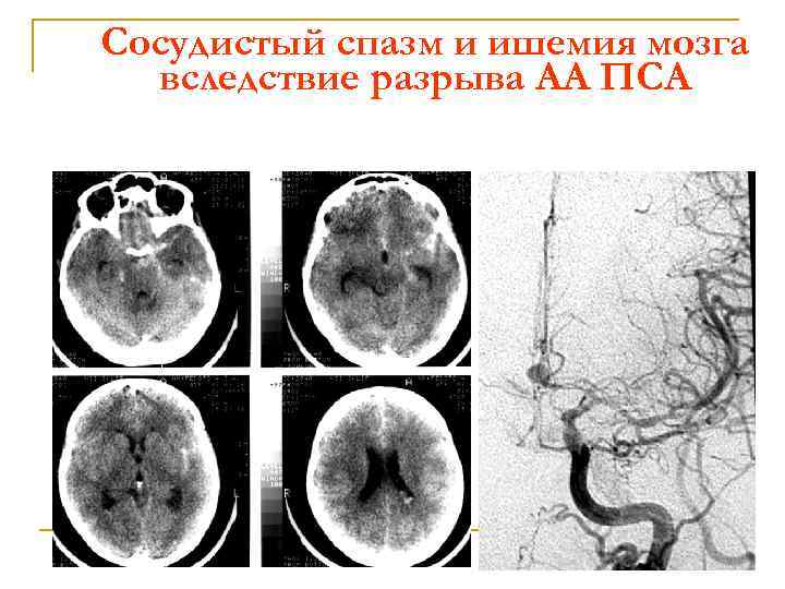 Сосудистый спазм и ишемия мозга вследствие разрыва АА ПСА 
