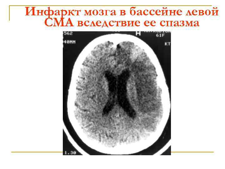 Инсульт в бассейне мозговой артерии. Инфаркт в бассейне левой средней мозговой артерии. Инфаркт головного мозга в бассейне левой средней мозговой артерии. Ишемический инсульт головного мозга в бассейне левой СМА. Инфаркт мозга в бассейне левой СМА.