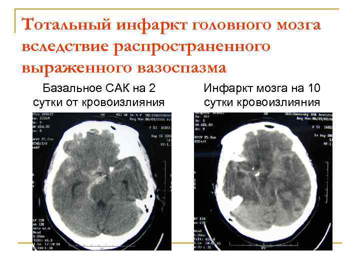 Тотальный инфаркт головного мозга вследствие распространенного выраженного вазоспазма Базальное САК на 2 сутки от
