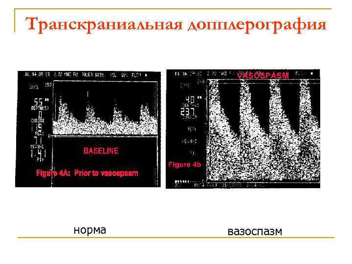 Транскраниальные артерии