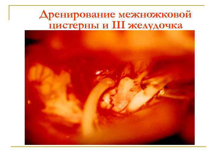 Дренирование межножковой цистерны и III желудочка 
