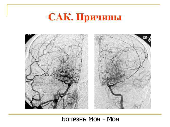 Болезнь моя моя. Моя моя болезнь симптомы. Болезнь моя-моя у детей.