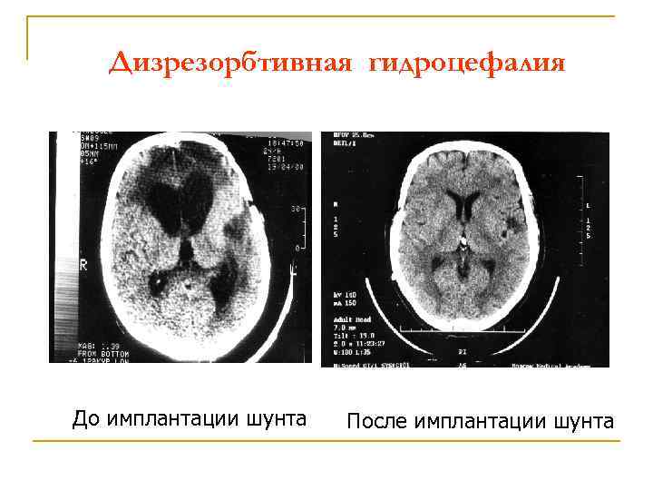 Дизрезорбтивная гидроцефалия До имплантации шунта После имплантации шунта 