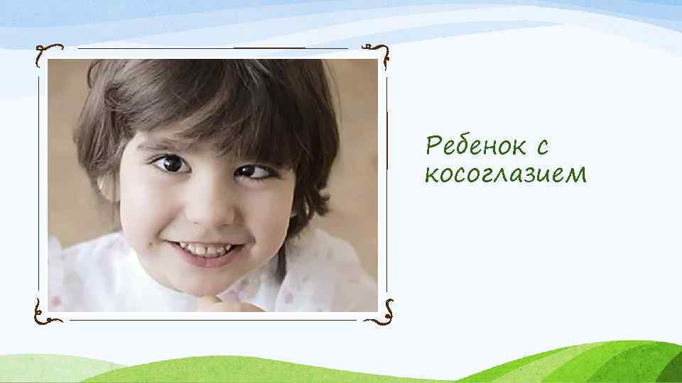 Ребенок с косоглазием 