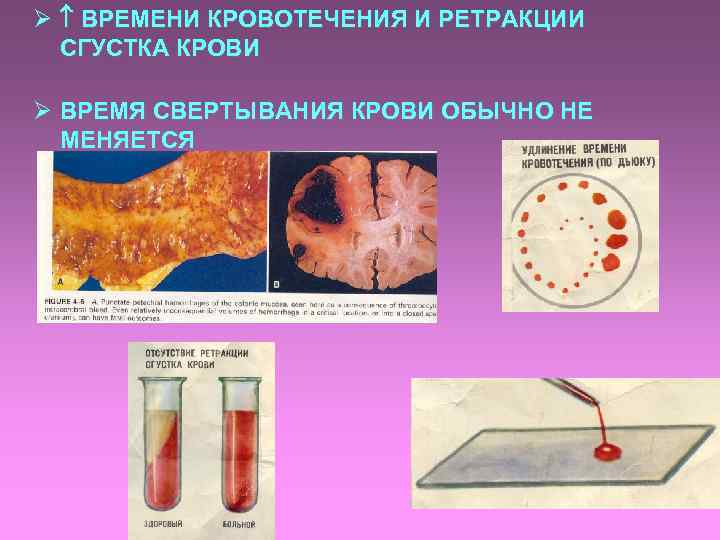 Ø ВРЕМЕНИ КРОВОТЕЧЕНИЯ И РЕТРАКЦИИ СГУСТКА КРОВИ Ø ВРЕМЯ СВЕРТЫВАНИЯ КРОВИ ОБЫЧНО НЕ МЕНЯЕТСЯ