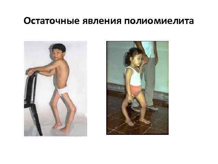 Остаточные явления полиомиелита 