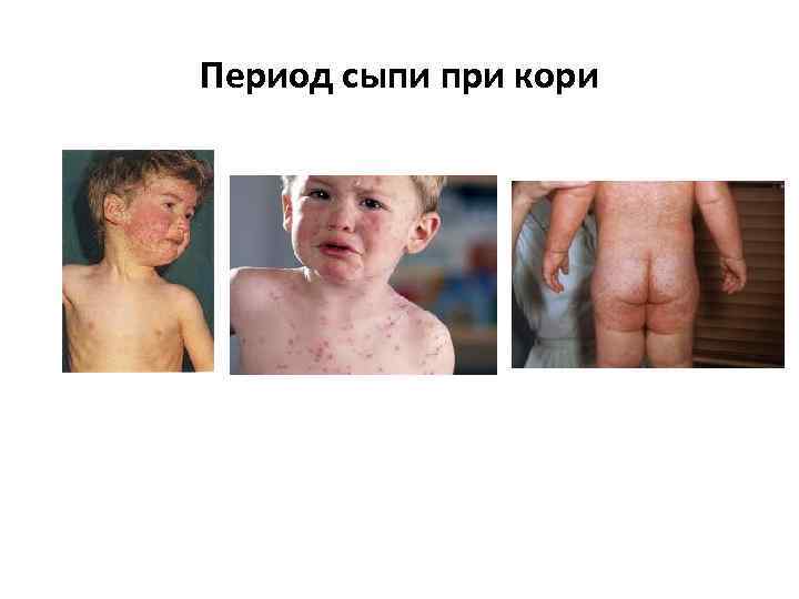 Период сыпи при кори 