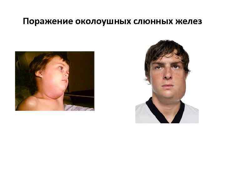 Поражение околоушных слюнных желез 