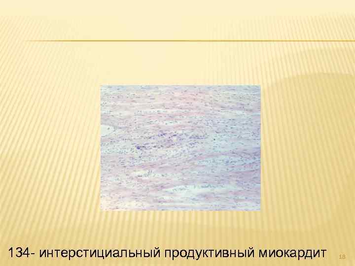 134 - интерстициальный продуктивный миокардит 18 