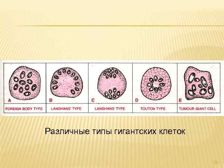 Различные типы гигантских клеток 21 