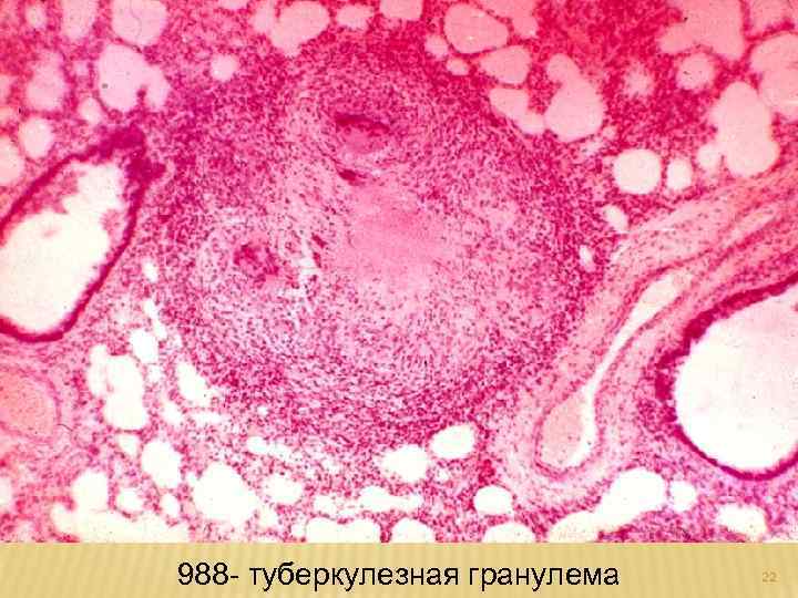 988 - туберкулезная гранулема 22 