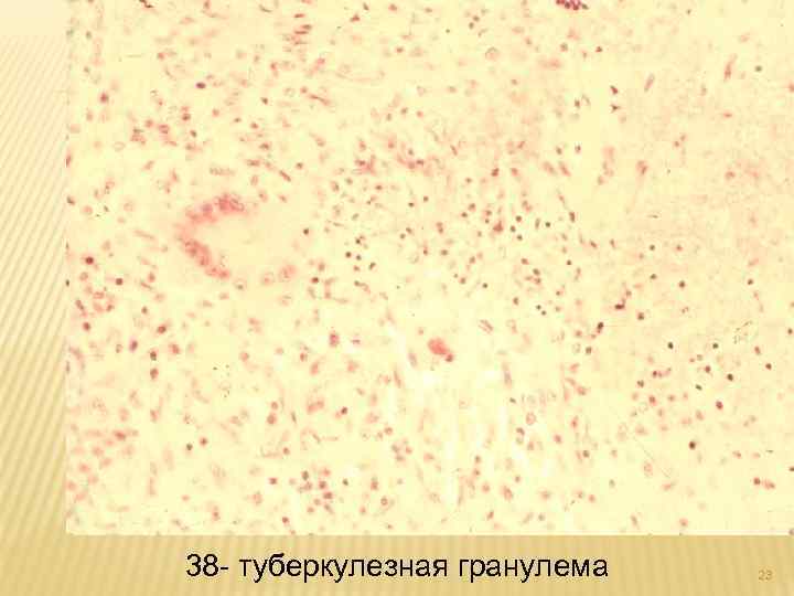 38 - туберкулезная гранулема 23 