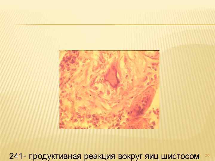 241 - продуктивная реакция вокруг яиц шистосом 30 