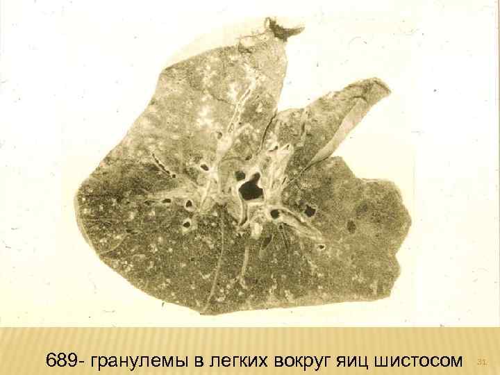 689 - гранулемы в легких вокруг яиц шистосом 31 