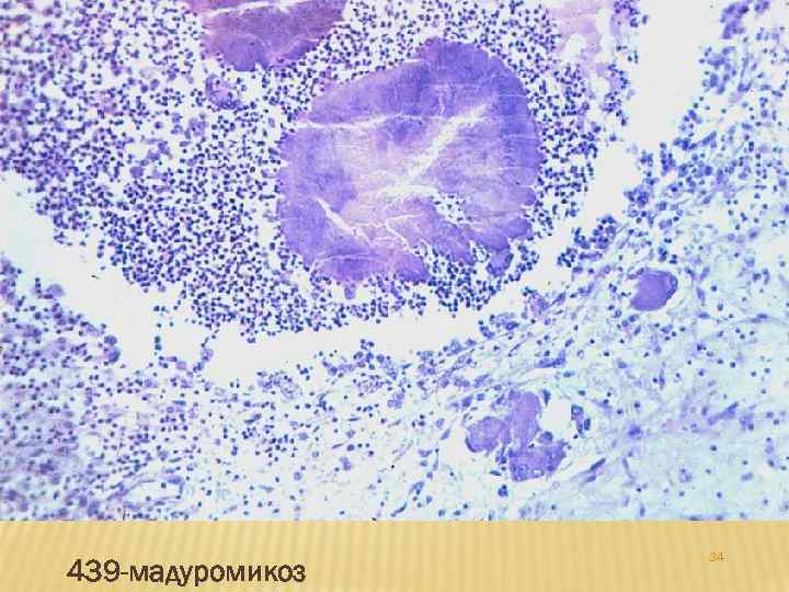 439 -мадуромикоз 34 