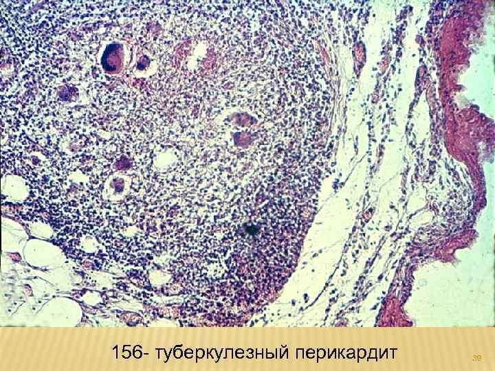 156 - туберкулезный перикардит 39 