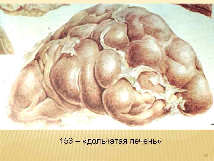 153 – «дольчатая печень» 43 