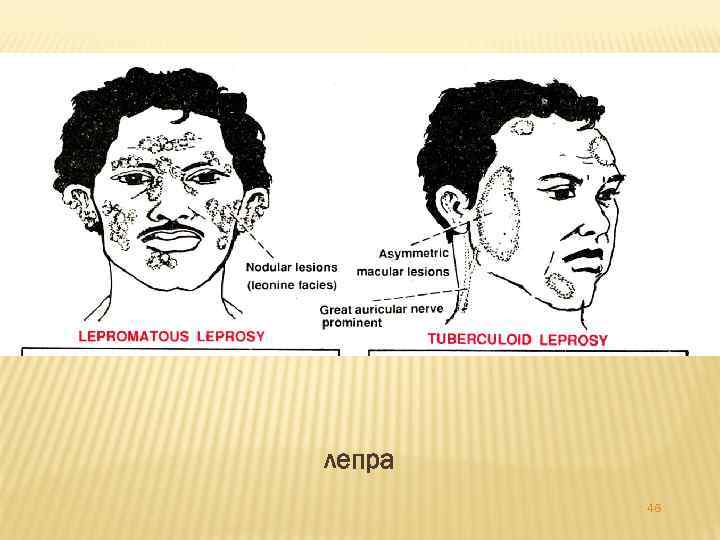 лепра 46 