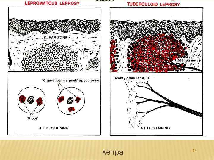 лепра 47 