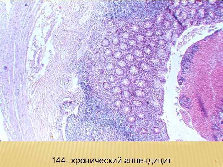 144 - хронический аппендицит 5 