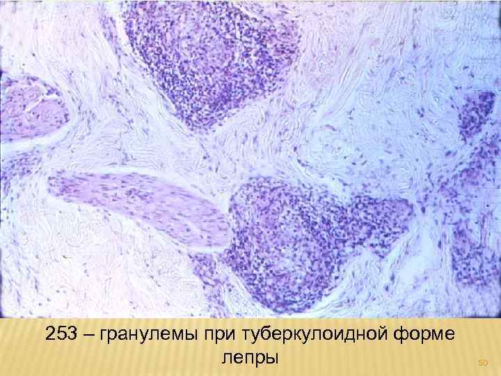 253 – гранулемы при туберкулоидной форме лепры 50 