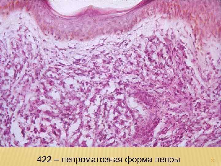 422 – лепроматозная форма лепры 51 