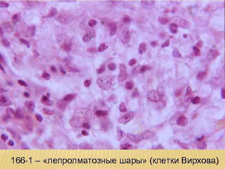 166 -1 – «лепролматозные шары» (клетки Вирхова) 52 