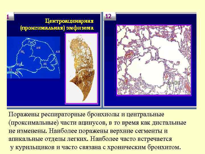 Поражены респираторные бронхиолы и центральные (проксимальные) части ацинусов, в то время как дистальные не