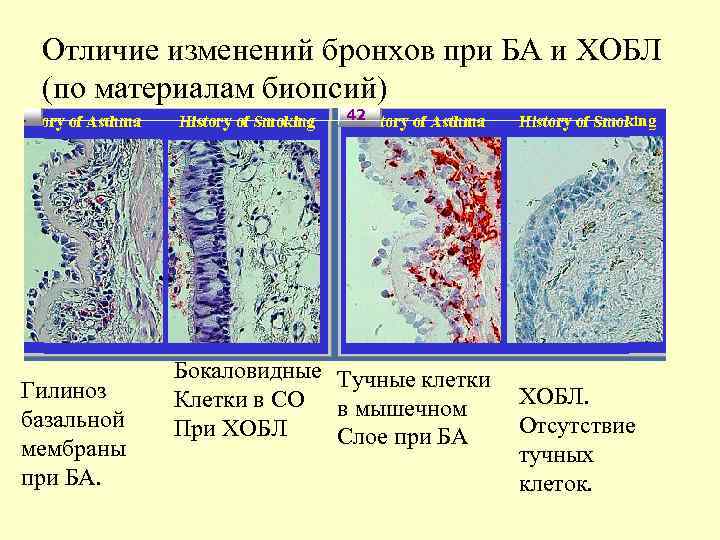 Отличие изменений бронхов при БА и ХОБЛ (по материалам биопсий) Гилиноз базальной мембраны при