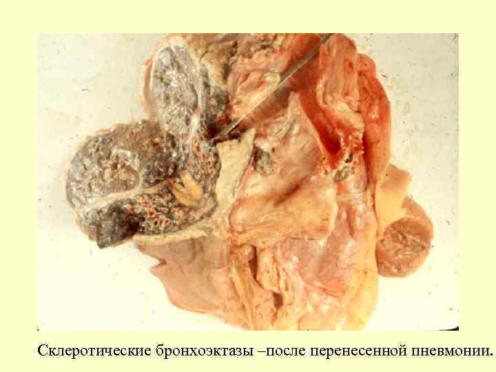 Склеротические бронхоэктазы –после перенесенной пневмонии. 