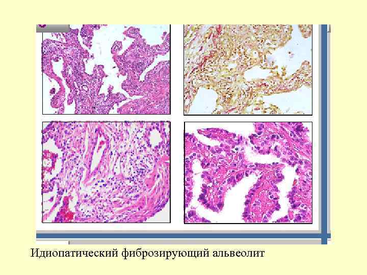Идиопатический фиброзирующий альвеолит 