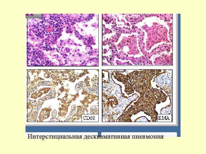 Интерстициальная десквамативная пневмония 