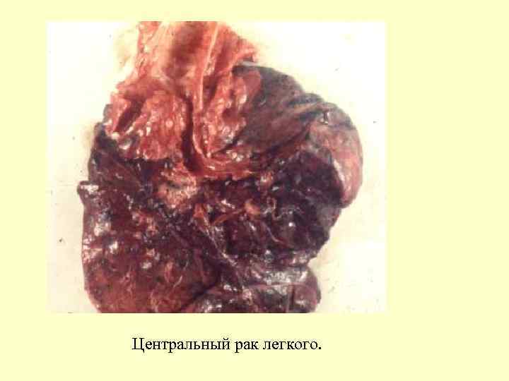 Центральный рак легкого. 