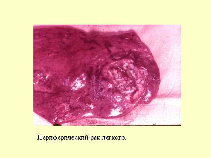 Периферический рак легкого. 