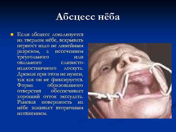 Абсцесс нёба n Если абсцесс локализуется на твердом нёбе, вскрывать периост надо не линейным