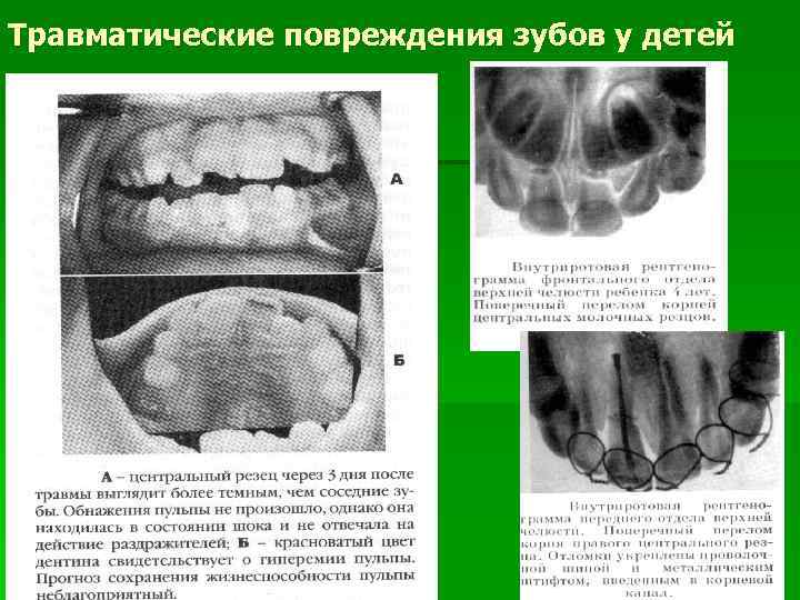 Травматические повреждения зубов у детей 