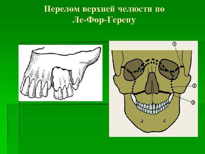 Перелом верхней челюсти презентация