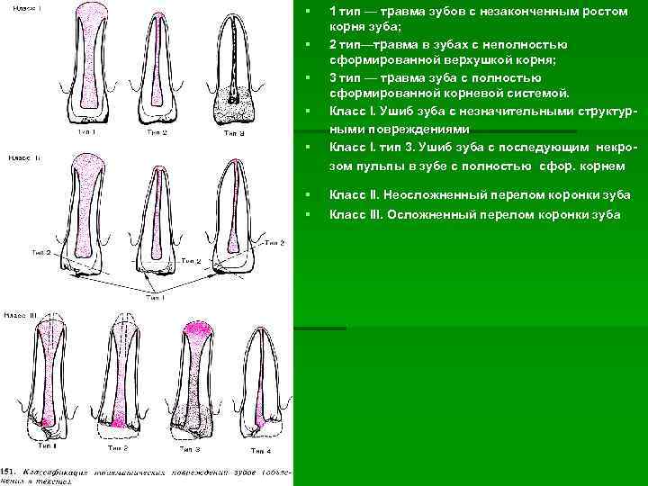  1 тип — травма зубов с незаконченным ростом корня зуба; 2 тип—травма в