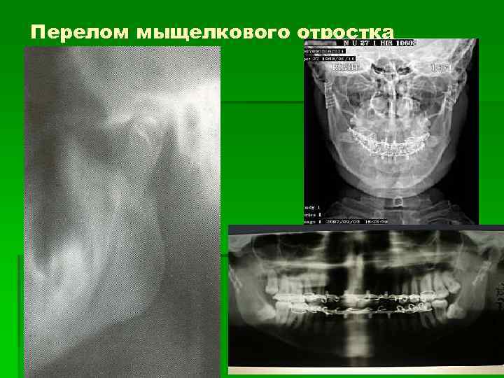 Перелом мыщелкового отростка 