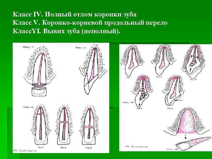 Класс IV. Полный отлом коронки зуба Класс V. Коронко-корневой продольный перело Класс. YI. Вывих