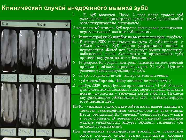 Клинический случай внедренного вывиха зуба 1 - 21 зуб вколочен. Через 2 часа после